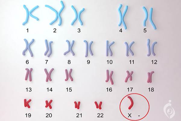 figure1)Karyotype of a person with Turner syndrome